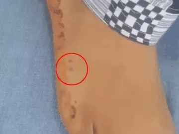 महिला को 6 महीने में 7वीं बार सांप ने डसा, फिर भी जिंदा है... इलाज करने वाले डॉक्टर भी हैरान