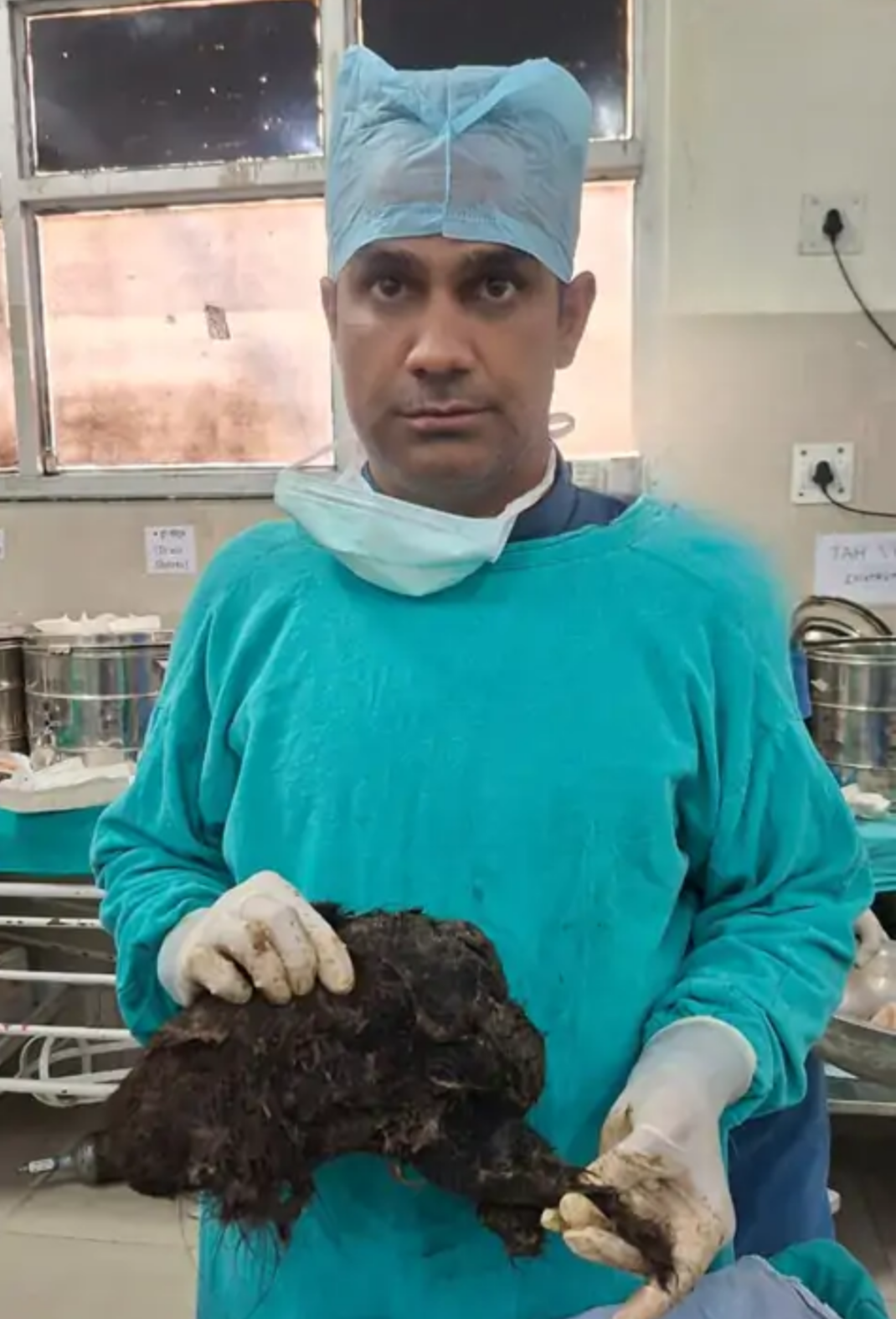 जयपुर - महिला के पेट से डॉक्टर्स ने निकाले 6 किलो वजन बालों का गुच्छा, महिला को बाल खाने की आदत है..खाने पीने में समस्या होने पर हॉस्पिटल आई थी